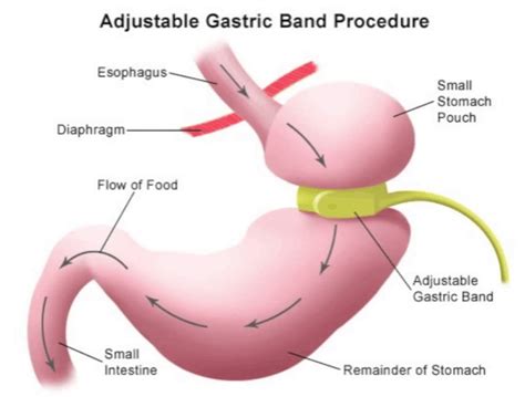 Gastric Band Surgery Cost – Greenbushes