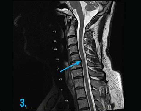 mri-cervical-spine-radiculopathy-gp-series - MRI at Melbourne Radiology ...