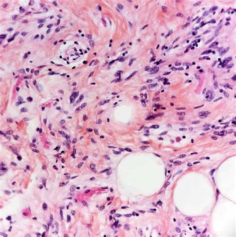 Spindle Cell Lipoma Histology