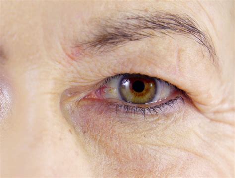 Droopy eyelids | Symptoms & Causes | Skin Institute