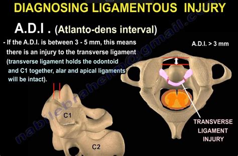 Jefferson’s Fracture — OrthopaedicPrinciples.com