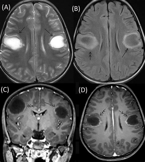 Frontiers | Neuromyelitis Optica Spectrum Disorder with Tumefactive ...