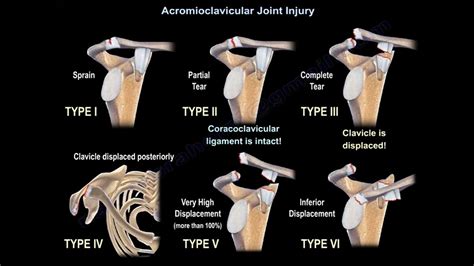 Acromioclavicular Joint Injury — OrthopaedicPrinciples.com