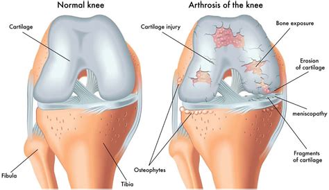 Osteoarthritis | Local Physio | Local Physio