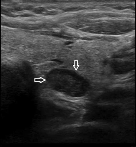 Ultrasound Elastography for Distinction Between Parathyroid Adenomas and Thyroid Nodules - Batur ...