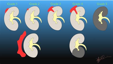 AAST Kidney Injury Scale | UW Emergency Radiology