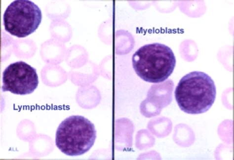 Lymphoblast