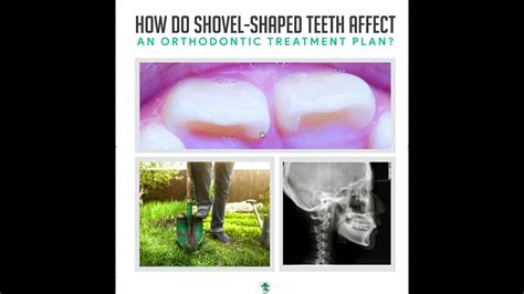 Shovel-Shaped Teeth, Orthodontics and Overjet - YouTube