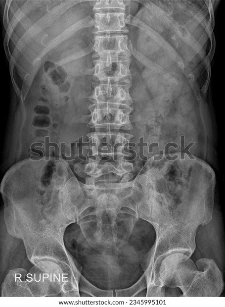 Kub Radiography Photos, Images and Pictures