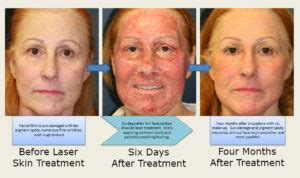 San Diego Laser Skin Resurfacing & Peels | Feel Beautiful