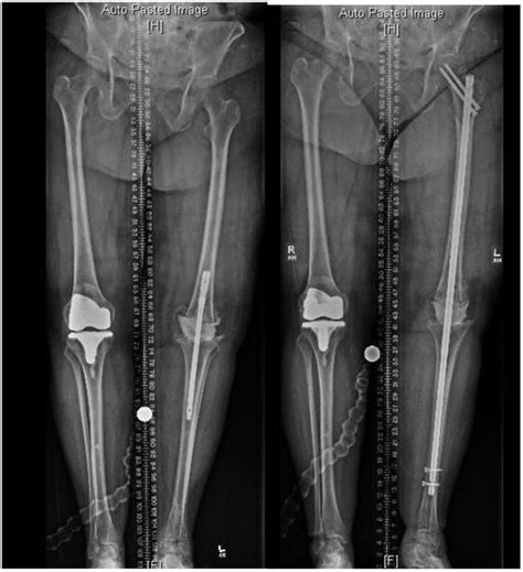 Cement Arthrodesis of the Knee with a Custom Long Recon Nail After Failed Total Knee ...