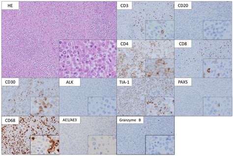 Pathological images of cervical lymph node biopsy on the 5th hospital ...