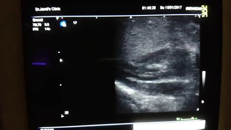 Normal Adrenal Ultrasound - YouTube