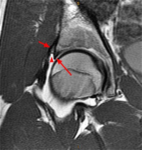 Labral Tear Of Hip