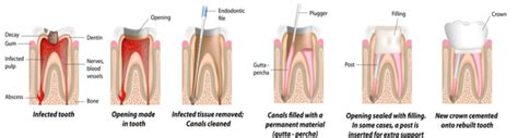 Endodontics/RCT