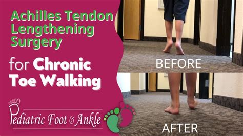 Achilles Tendon Lengthening Surgery for Toe Walking Male 7 Years Old ...