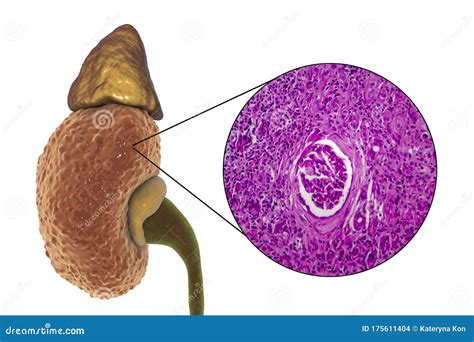 Chronic Glomerulonephritis, Gross Pathology Stock Illustration - Illustration of composite ...