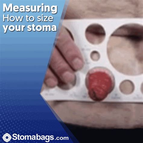 Pin by Stomabags.com on Colostomy | Ostomy, Colostomy, Ileostomy