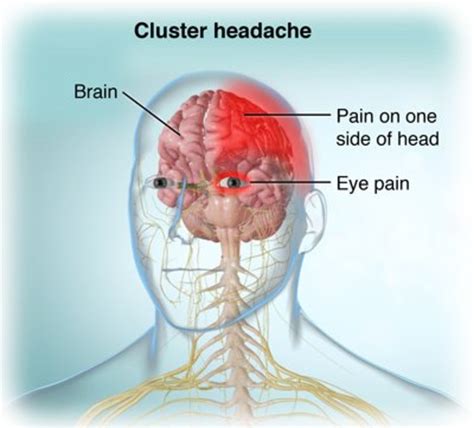 Cluster Headache Characteristics - YouMeMindBody