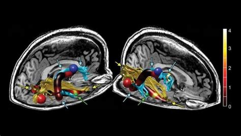 Brain Abnormalities Discovered in Patients With Chronic Fatigue Syndrome | IFLScience