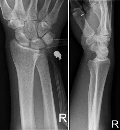 An unusual wrist injury • LITFL • Clinical Cases Bamboozler