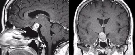 Pituitary Adenoma