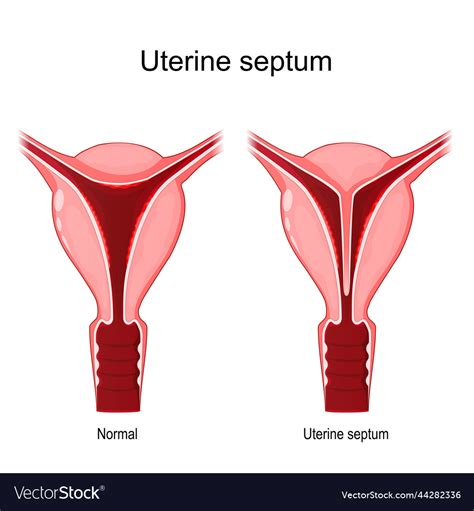 Uterine septum Royalty Free Vector Image - VectorStock