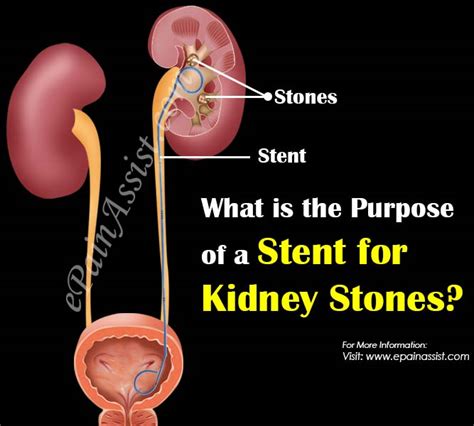 What is the Purpose of a Stent for Kidney Stones?