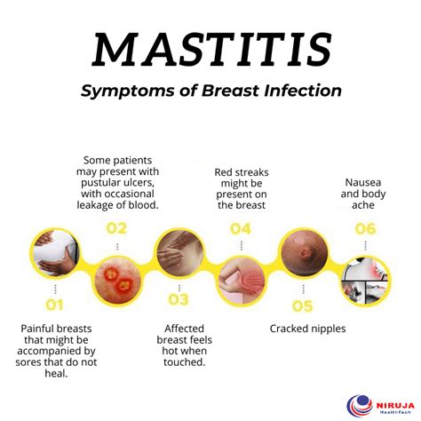 Mastitis: Symptoms of Breast Infection