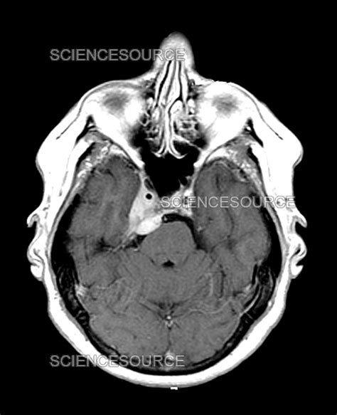 Photograph | Skull Base Meningioma, MRI | Science Source Images