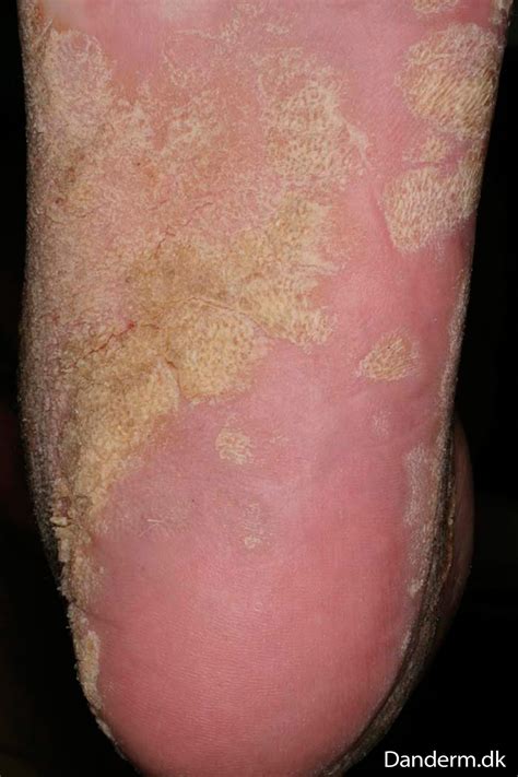 5-67-9 keratoderma plantar 2 of 2