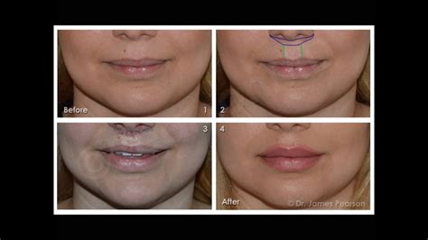 Lip Lift - Dr. James Pearson Facial Plastic Surgery - YouTube