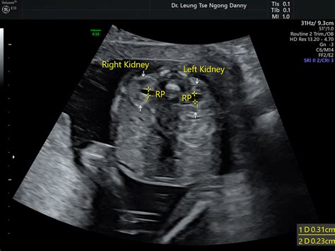 Fetal Hydronephrosis Ultrasound