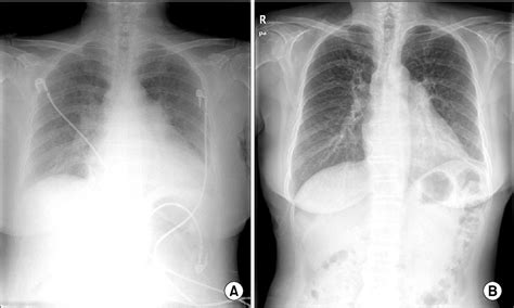 Figure 1 from A Case of Severe Human Metapneumovirus Pneumonia ...