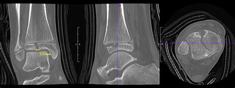 Triplane ankle fractures - Don't Forget the Bubbles