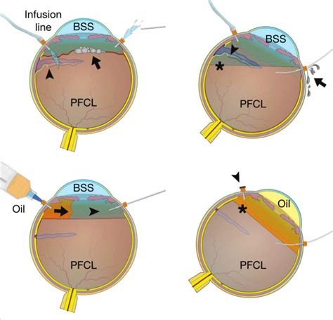 Fluid currents lead to formation of bubbles over perfluorocarbon liquid ...