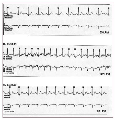 Sinus Tachycardia