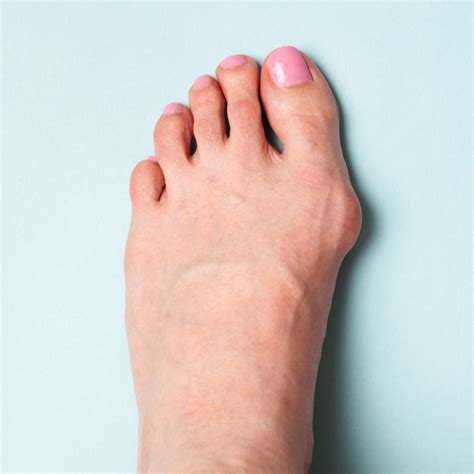 Bunion Surgery Alternatives - Triad Foot & Ankle Center