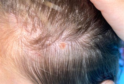 Early stage melanoma on scalp pictures | Symptoms and pictures