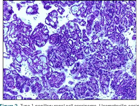 Figure 1 from Icteric Variant of Stauffer Syndrome as a Paraneoplastic Manifestation of Type 1 ...