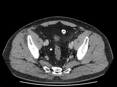 Appendix Epiploica Ct