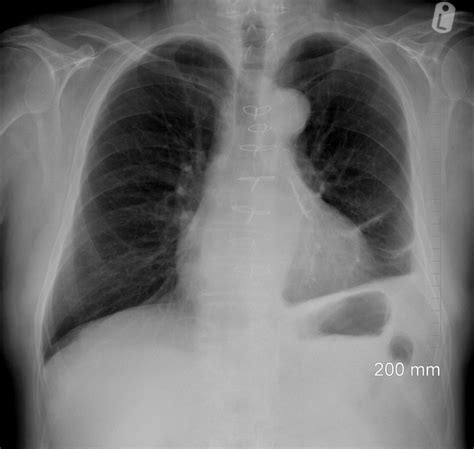 left atrial appendage occlusion devices | pacs