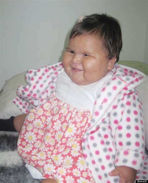 Obese Baby With Mystery Illness Weighs 20Kgs At Just 10 Months Old