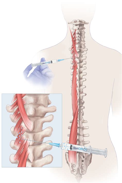 Degenerative Spine Treatment StemCells21 Best Treatment