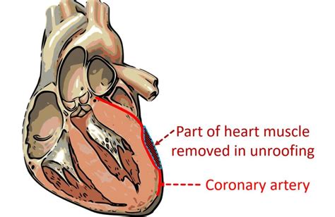 Unroofing of myocardial bridge – All About Cardiovascular System and ...