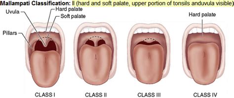 Is the Mallampati Score Useful for Emergency Department Airway Management or Procedural Sedation ...