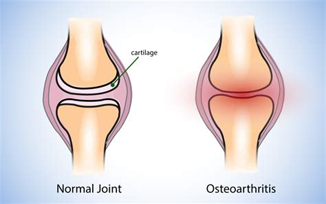 Spinal Osteoarthritis – Dr Usamah Jannoun