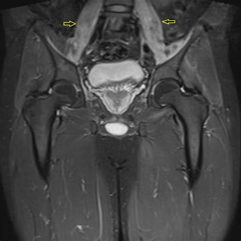 Cureus | A Case of Sjögren's Syndrome Mimicking Inflammatory Myopathy