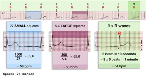 Ecg Heart Rate Calculation