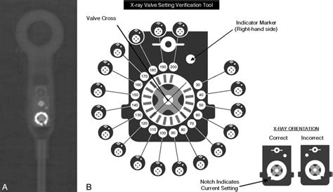 Determining Settings of Programmable VP Shunts | UW Emergency Radiology